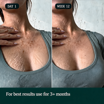 Stretch Treatment Starter Kit